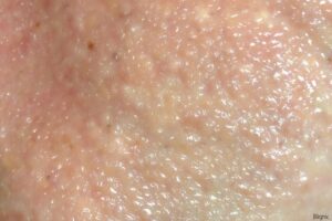 Trypophobie : comprendre et traiter la peur des trous