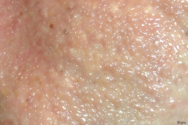 Trypophobie : comprendre et traiter la peur des trous